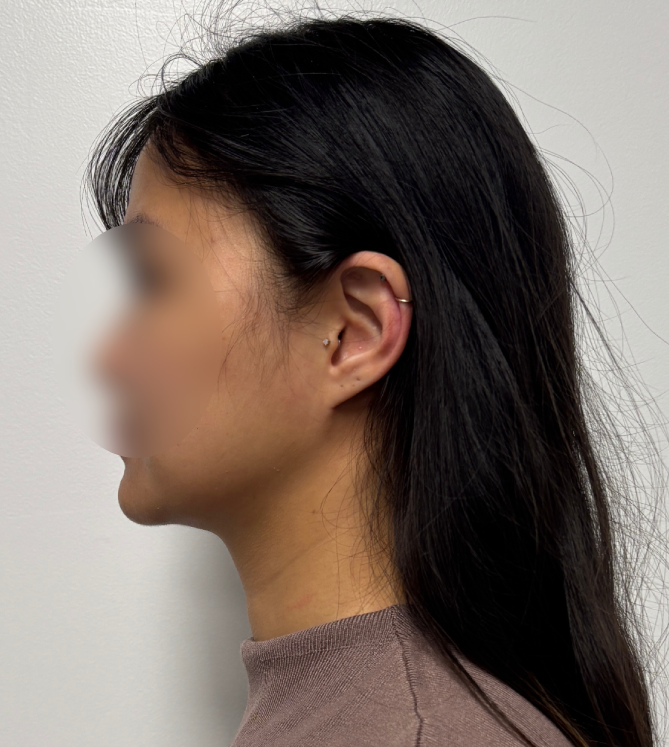Procedure before and after - after