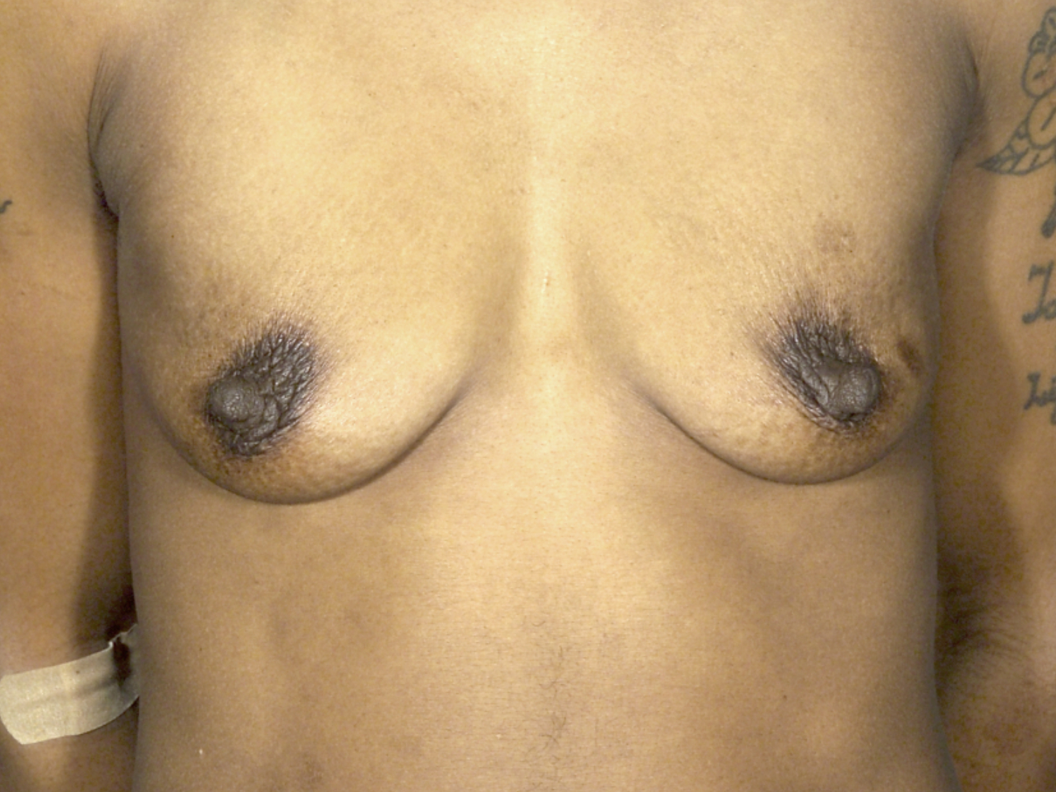 Breast Augmentation before and after - before