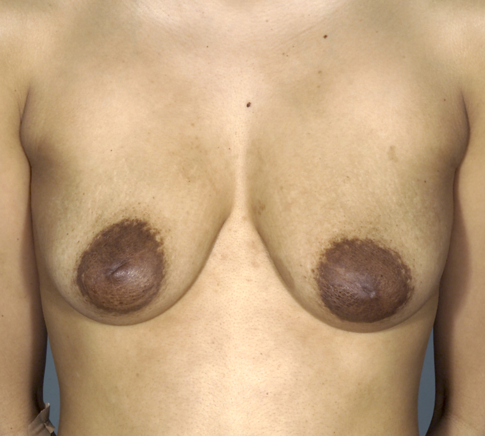 Breast Augmentation and Lift before and after - before