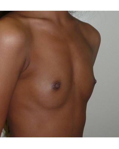 Procedure before and after - before
