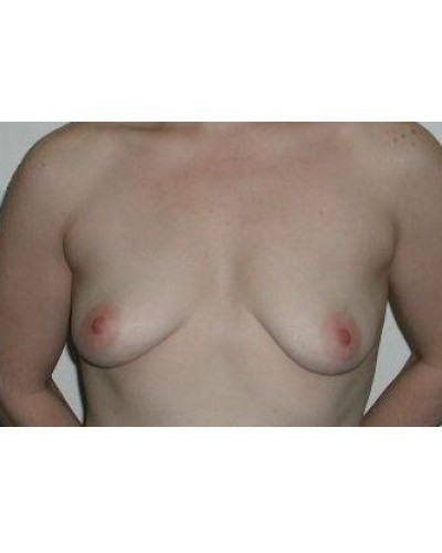 Breast Augmentation before and after - before