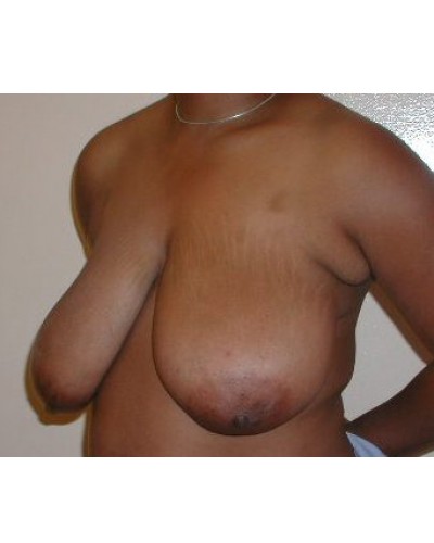 Procedure before and after - before