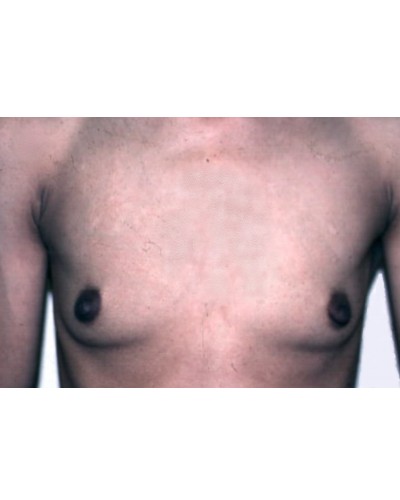 Breast Augmentation before and after - before