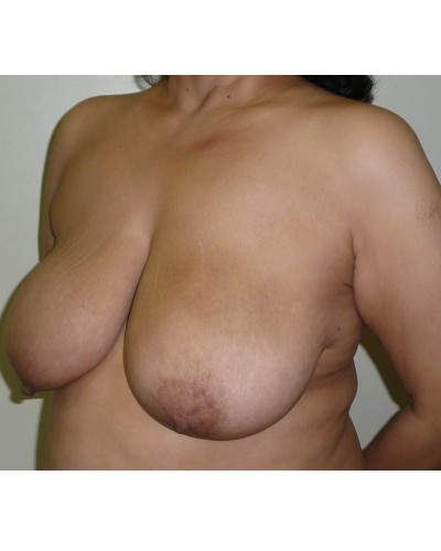 Procedure before and after - before