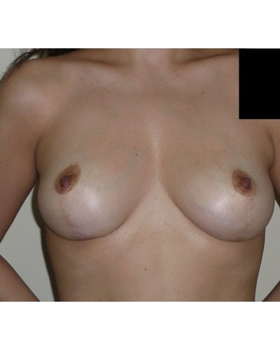 Procedure before and after - after