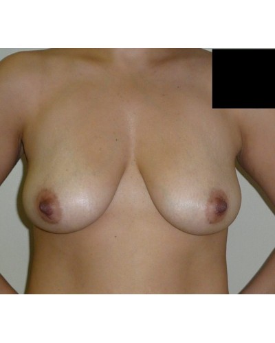 Procedure before and after - before