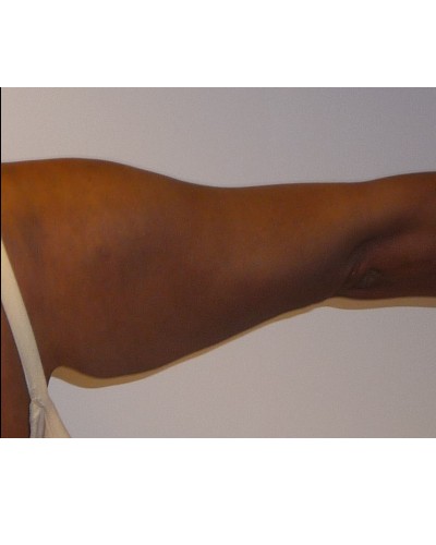 Procedure before and after - before