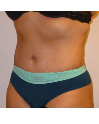 Procedure before and after - after