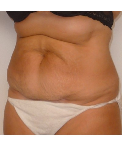 Procedure before and after - before