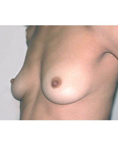 Breast Augmentation before and after - before