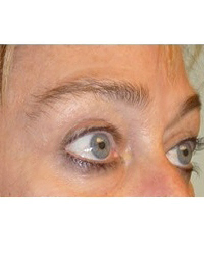 Procedure before and after - after