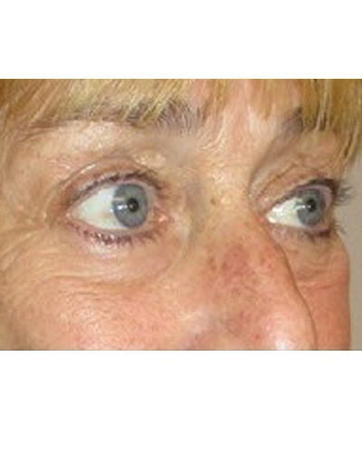 Procedure before and after - before