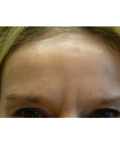 Procedure before and after - after