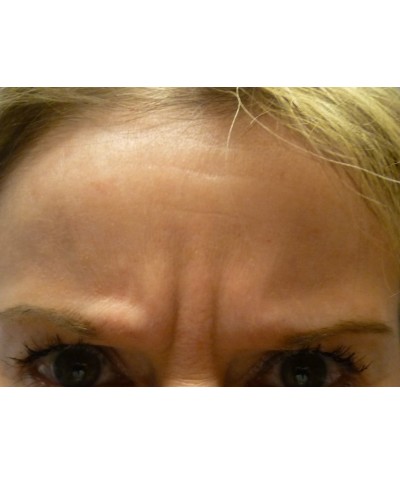 Procedure before and after - before