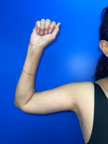 Arm Plasty before and after - after