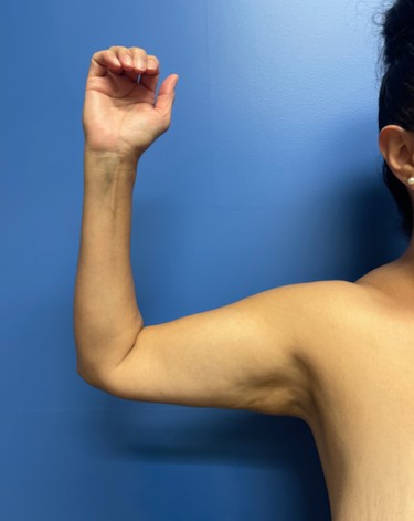 Arm Plasty before and after - before