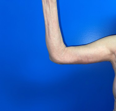 Arm Plasty before and after - after