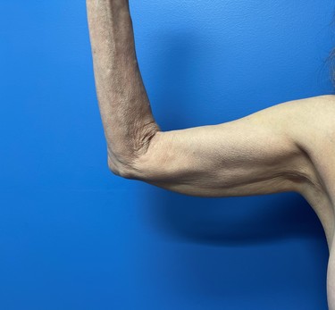Arm Plasty before and after - before