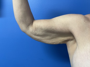 Arm Plasty before and after - before