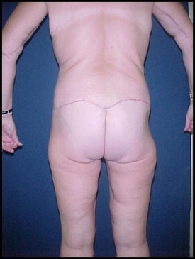Body Lift before and after - after