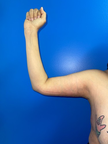 Arm Plasty before and after - after