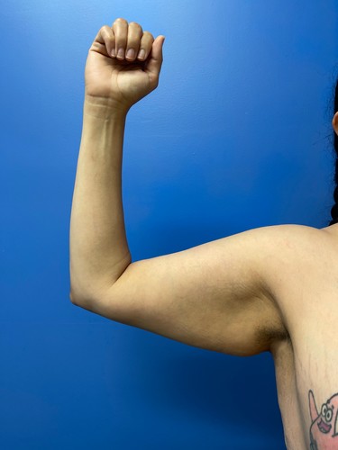 Arm Plasty before and after - before