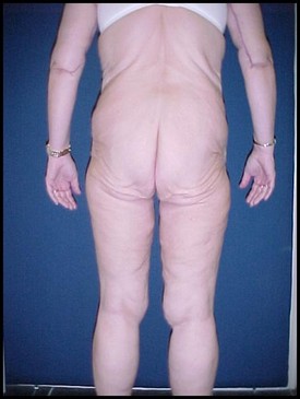 Body Lift before and after - before