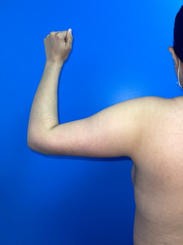 Arm Plasty before and after - after