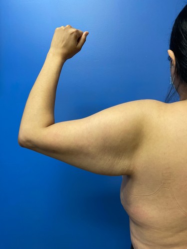 Arm Plasty before and after - before
