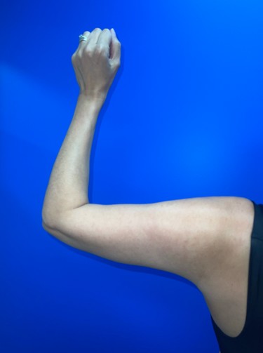 Arm Plasty before and after - after