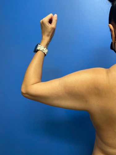 Arm Plasty before and after - before