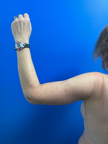 Arm Plasty before and after - after