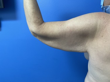 Arm Plasty before and after - before