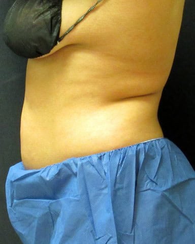 Breast Lift after — Dr. Pauline Joy Santos