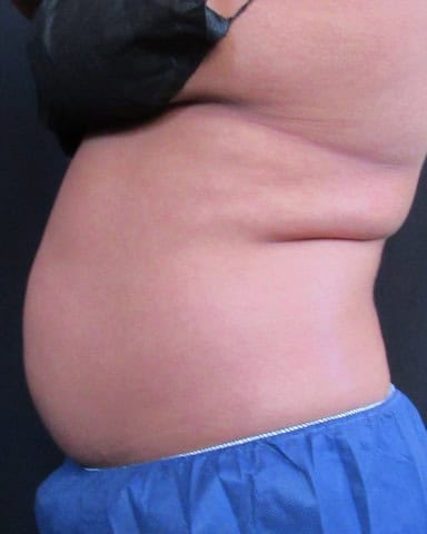 Breast Lift before — Dr. Pauline Joy Santos
