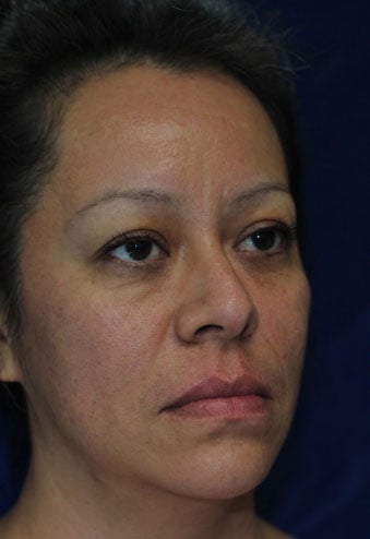Procedure before and after - before