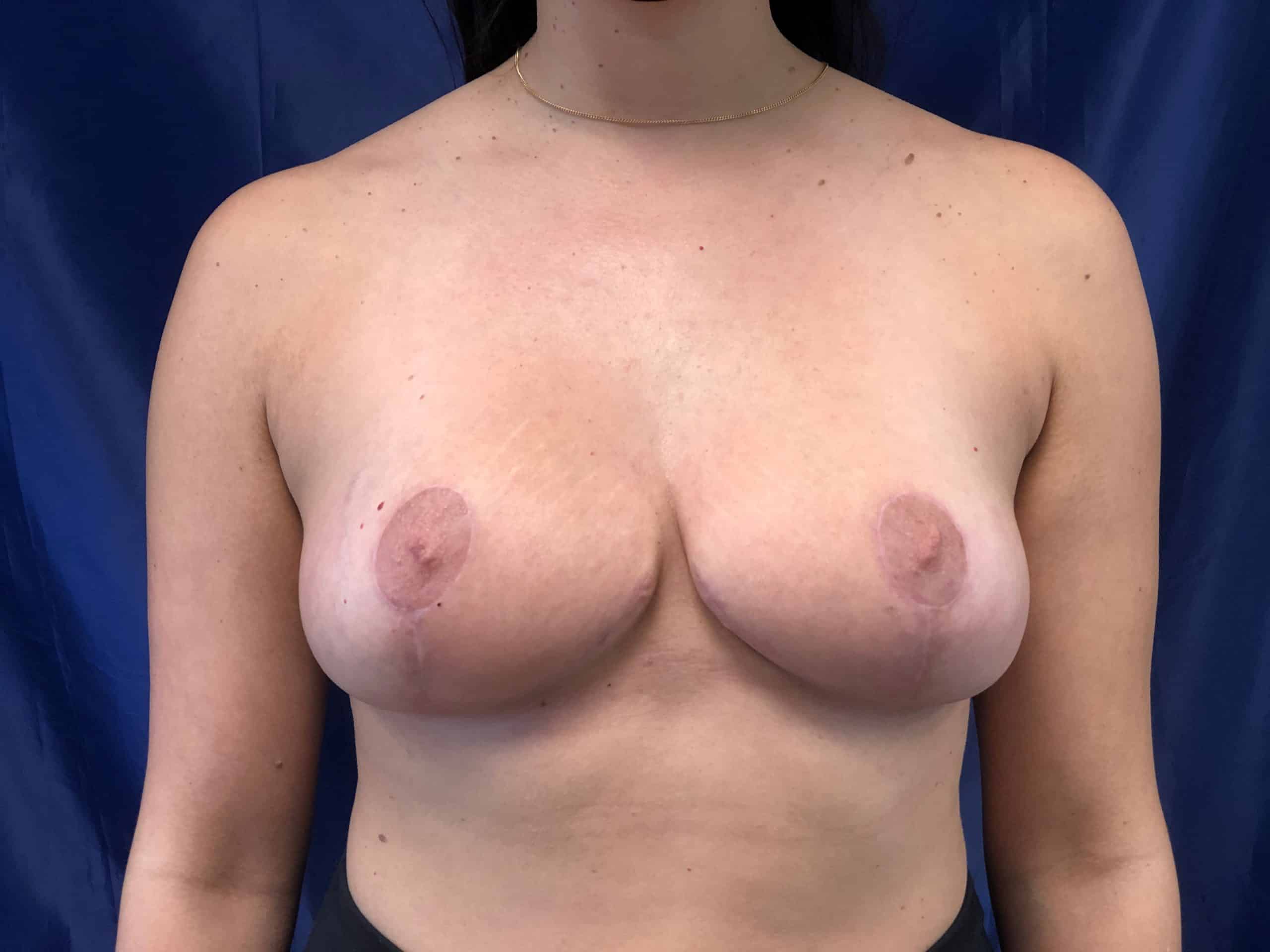 Procedure before and after - after