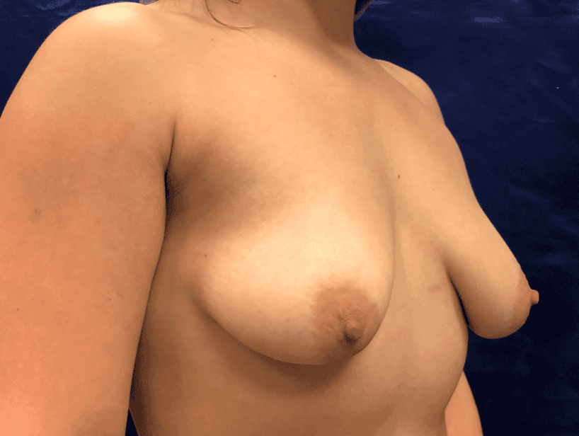 Breast Lift before — Dr. Pauline Joy Santos