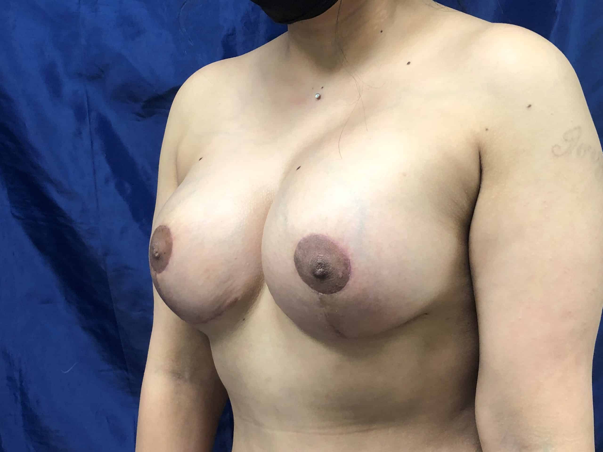 Breast Lift after — Dr. Pauline Joy Santos