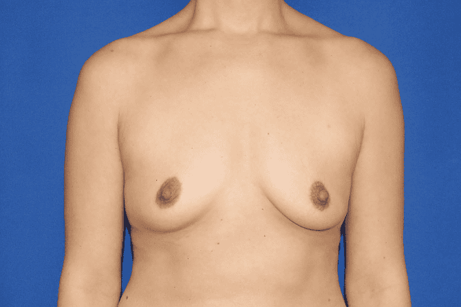 Breast Augmentation before and after - before