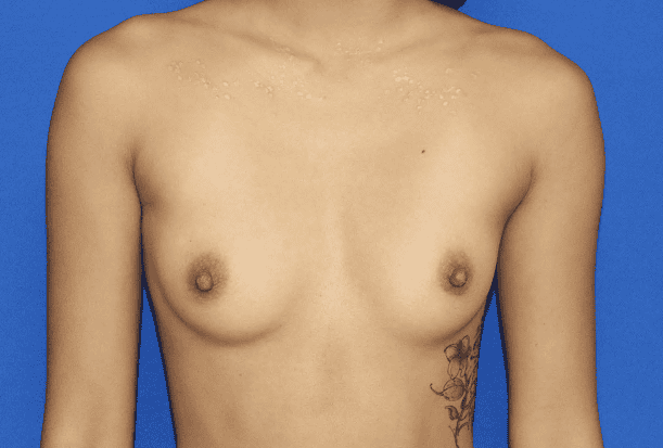Breast Augmentation before — Dr. Pauline Joy Santos