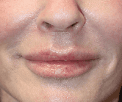 Procedure before and after - after