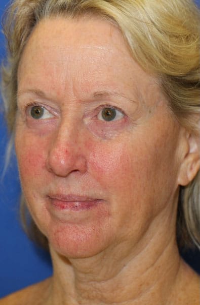 Procedure before and after - before