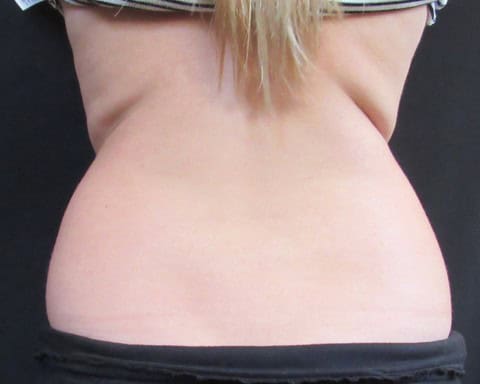Breast Lift before — Dr. Pauline Joy Santos