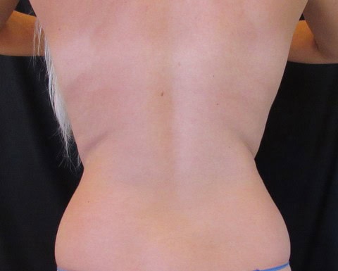 BBL before and after - after