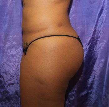 BBL before and after - before