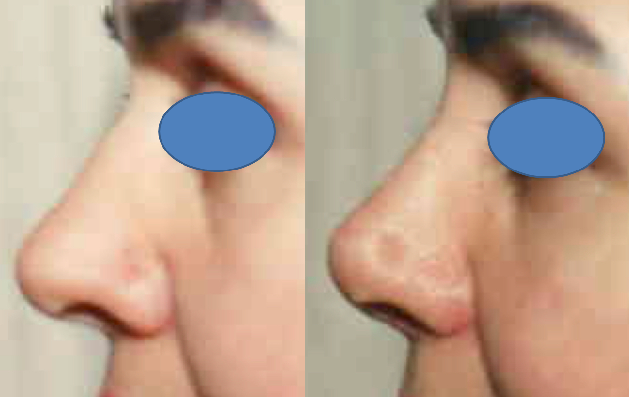 Rhinoplasty before and after - after