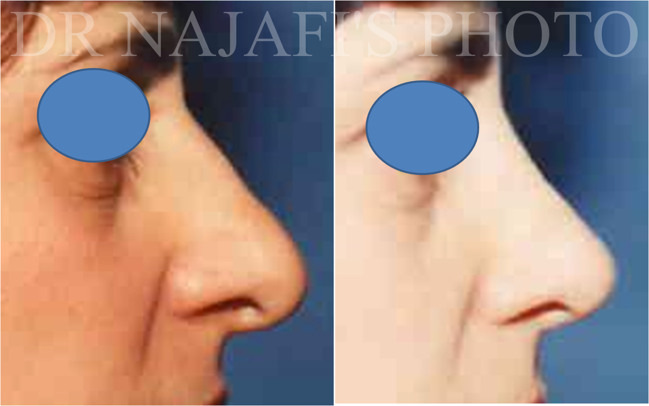 Rhinoplasty before and after - before