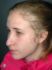 Rhinoplasty before and after - before