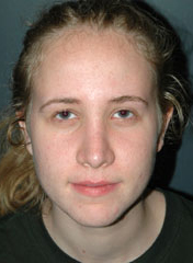 Rhinoplasty before and after - after